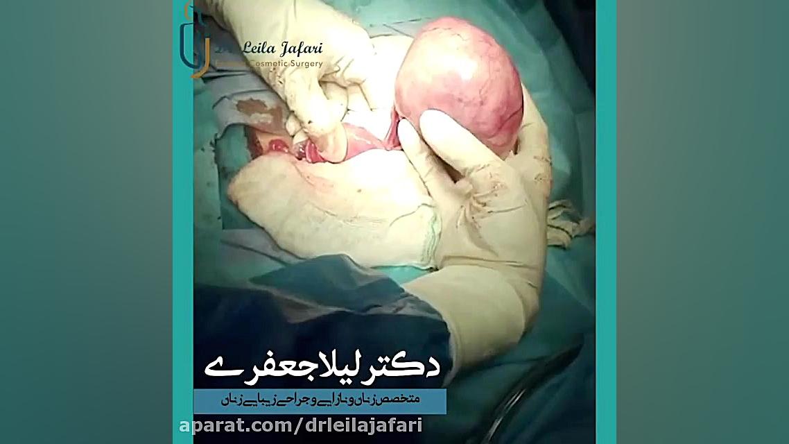 فیلم واقعی جراحی کیست تخمدان دکتر لیلا جعفری