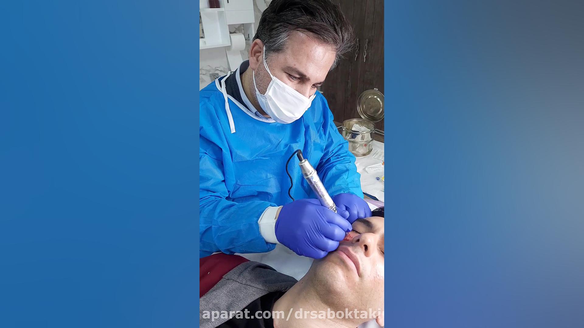 میکرونیدلیگ برای رفع منافذ و اسکار آکنه متخصص پوست اصفهان دکتر مهدی سبکتکین