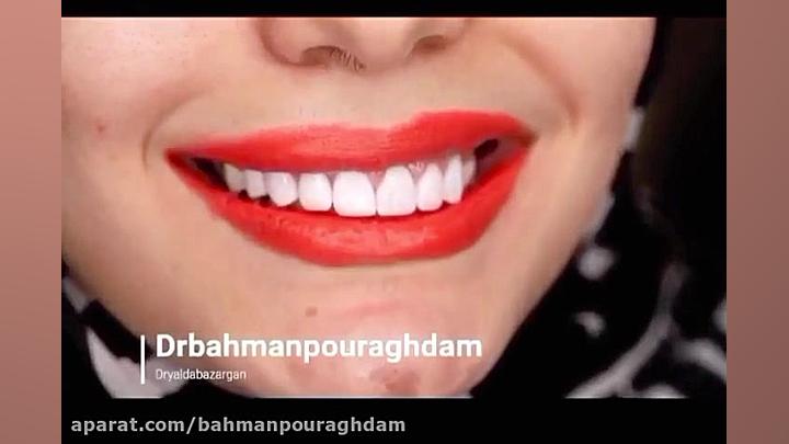 بهترین روکش سرامیکی دندان (دکتر بهمن پوراقدم) 02122220000 دکتر بهمن پوراقدم 02122220000
