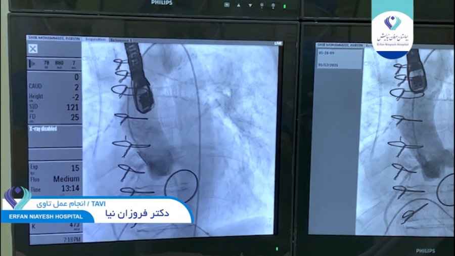 انجام عمل تاوی توسط Heart Team DLCO