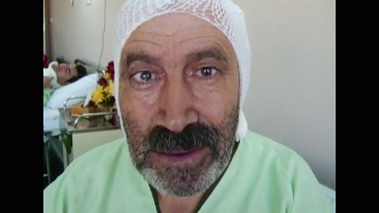 همي فيشيال اسپاسم بررسی لک صورت