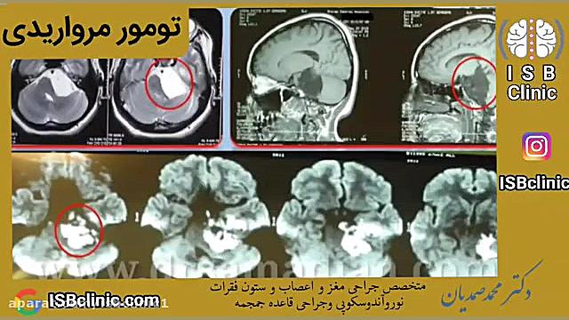 تومور مرواریدی جرمگیری