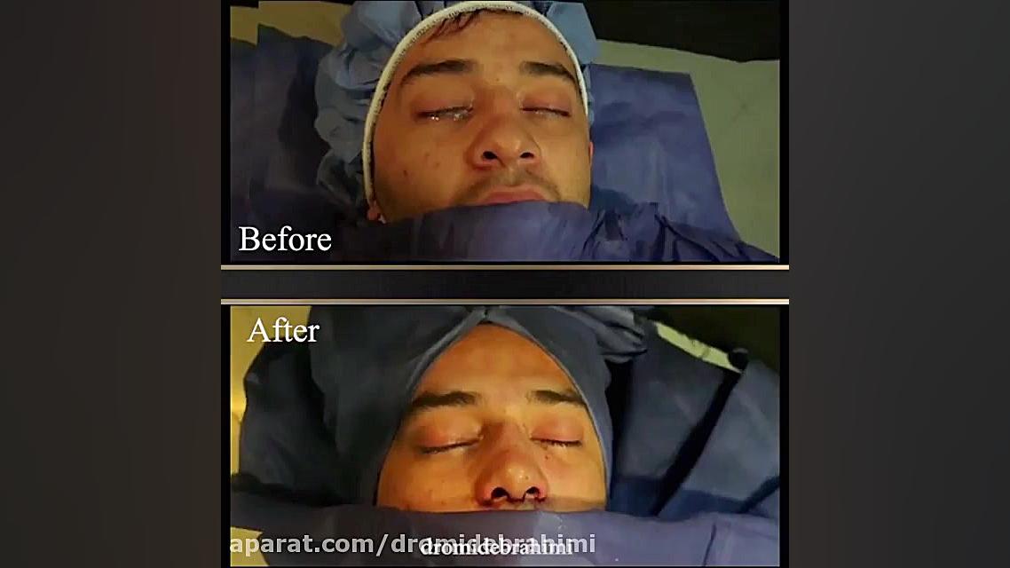 بلافاصله بعد از عمل زیبایی بینی توسط دکتر امید ابراهیمی، بهترین جراح بینی دکتر امید ابراهیمی