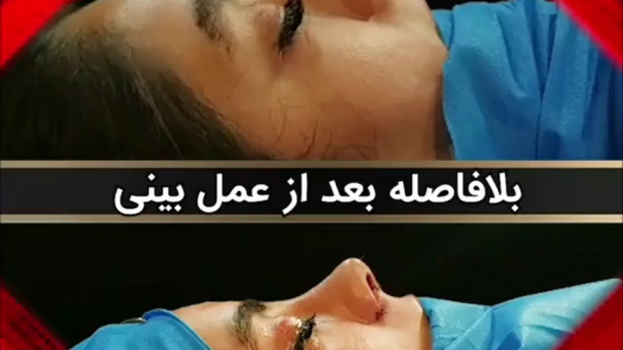 عمل زیبایی بینی گوشتی توسط دکتر امید ابراهیمی دکتر امید ابراهیمی