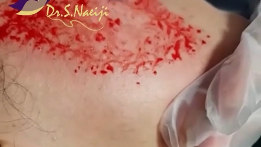 فیلم واقعی و بدون سانسور میکرونیدلینگ برای درمان جای زخم دکتر صدیقه نائیجی | متخصص پوست و مو در قم