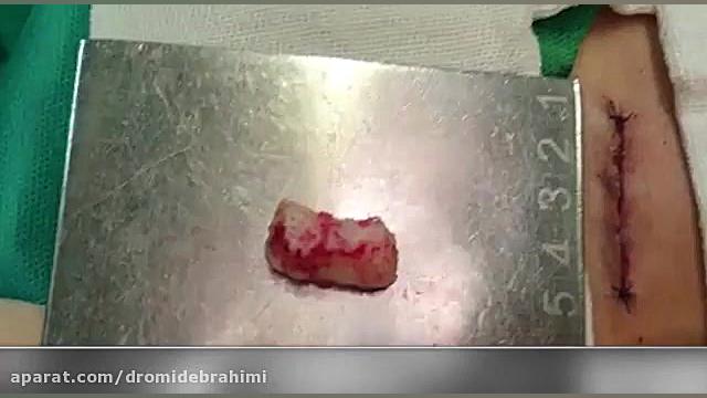 استفاده از غضروف دنده برای جراحی بینی ترمیمی توسط دکتر امید ابراهیمی دکتر امید ابراهیمی