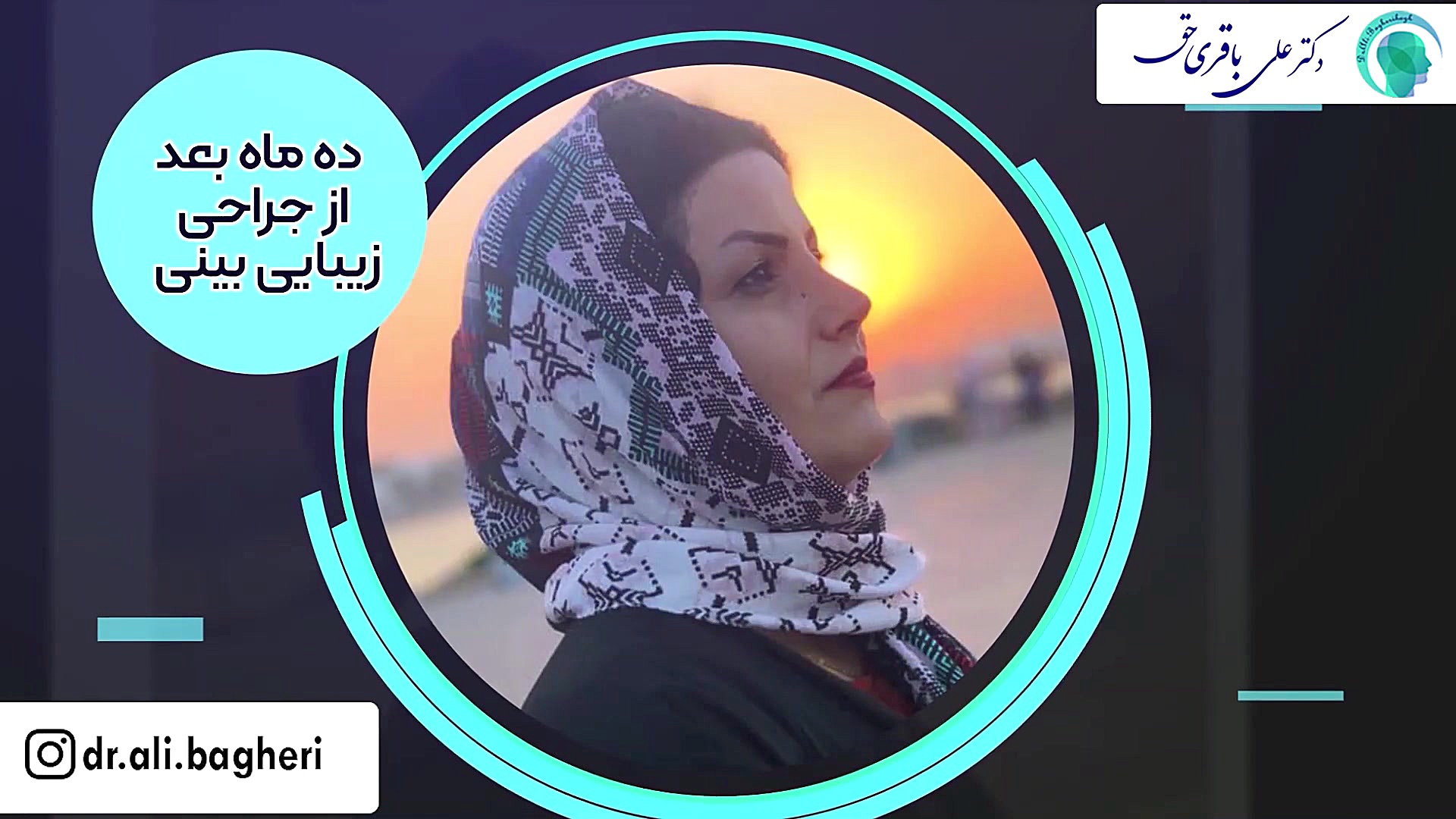 ده ماه بعد از جراحی بینی دکتر علی باقری حق