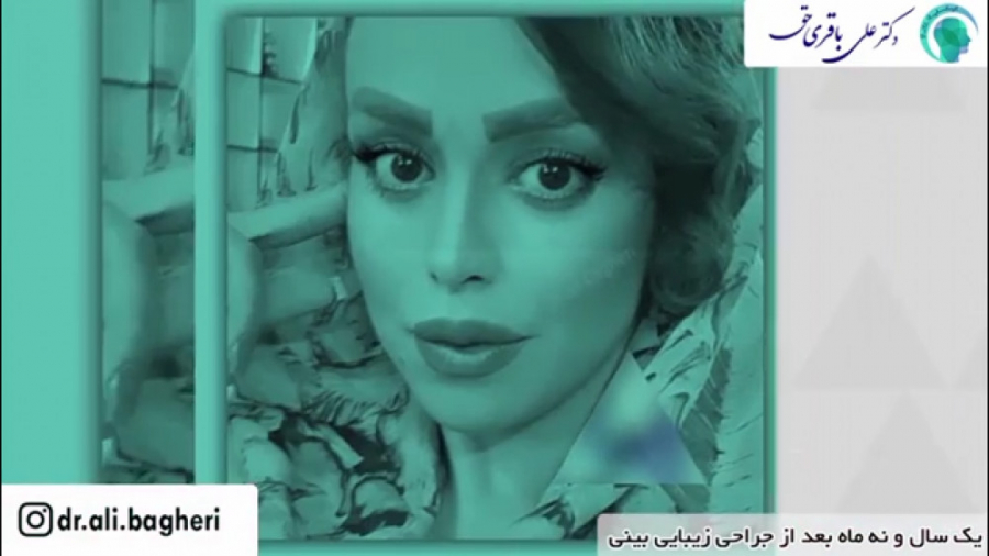 یک سال و نه ماه بعد از جراحی زیبایی بینی دکتر علی باقری حق