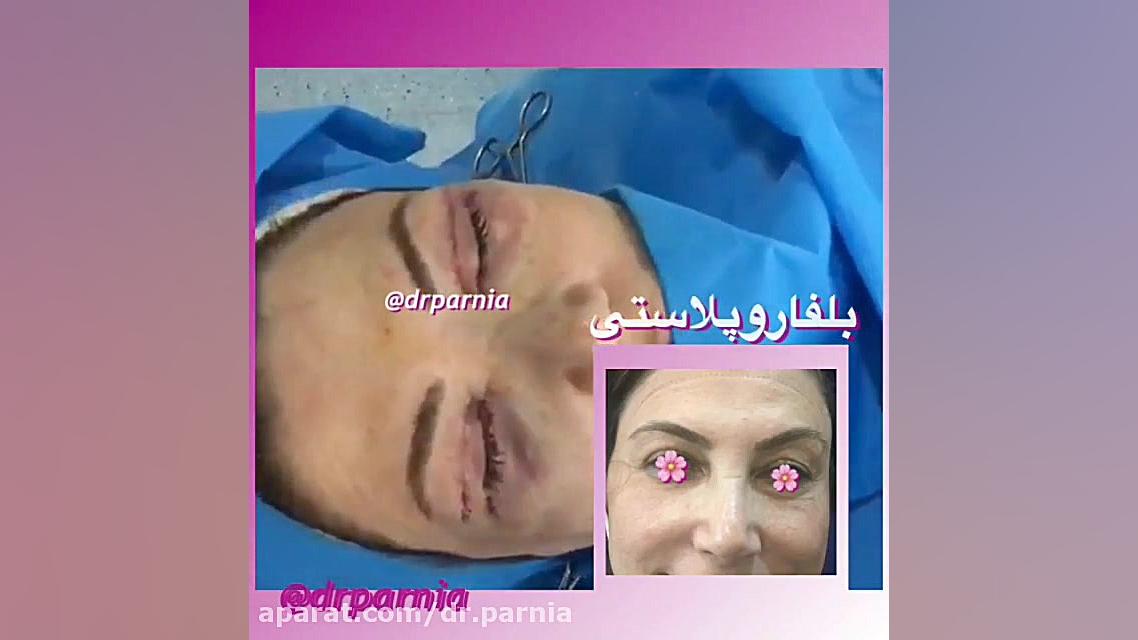 فیلم بلفاروپلاستی یا جراحی پلک دکتر رفیع پرنیا فوق تخصص پلاستیک