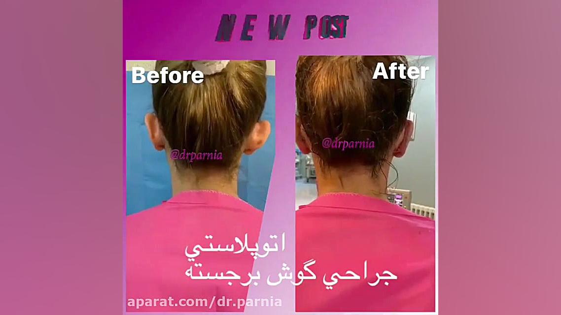 اتوپلاستی جراحی گوش برجسته دکتر رفیع پرنیا فوق تخصص پلاستیک
