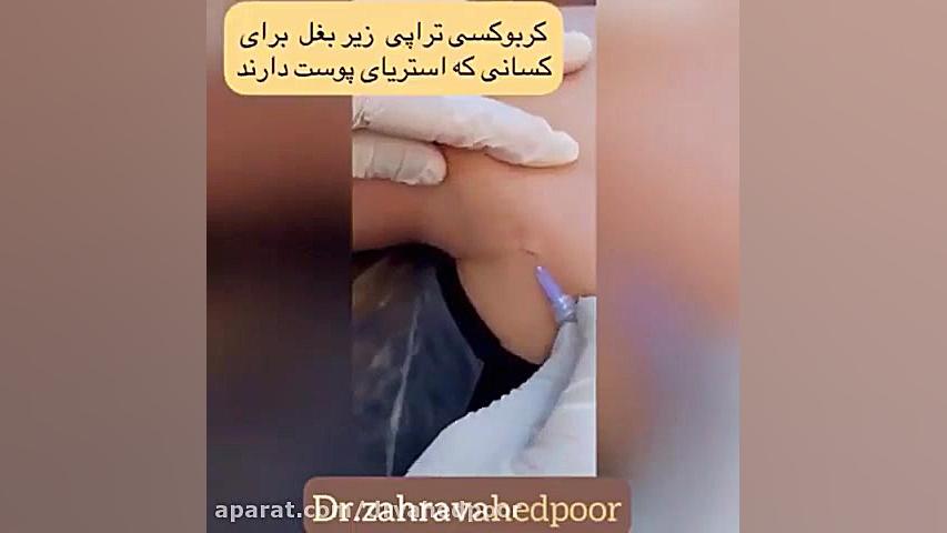 فیلم کربوکسی تراپی زیر بغل لیزر صورت