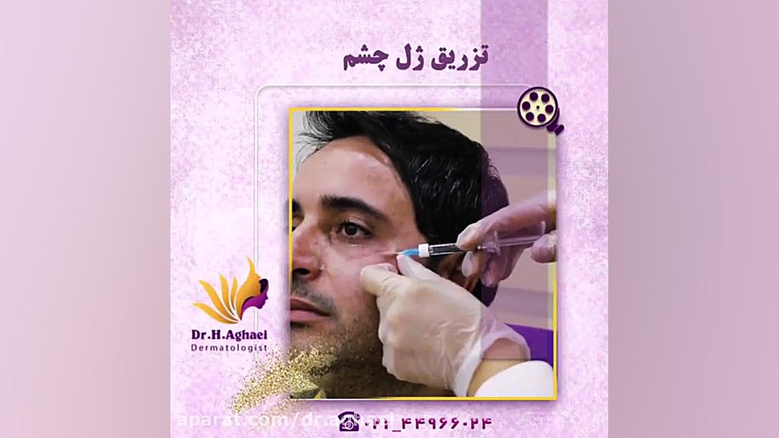 تزریق ژل زیر چشم دکتر حمیده آقایی