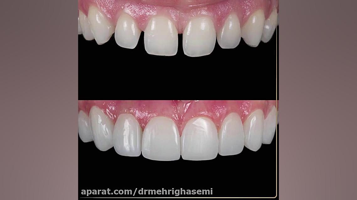 اصلاح طرح لبخند و بستن فواصل بین دندانی (دیاستم) | کلینیک دندانپزشکی دکتر قاسمی مرکز دندانپزشکی دیجیتال دکتر مهری قاسمی