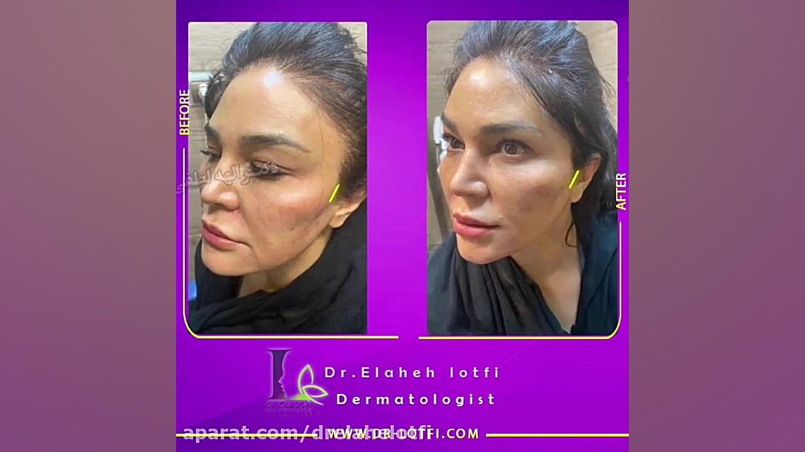 هایفوتراپی صورت جراحی لثه