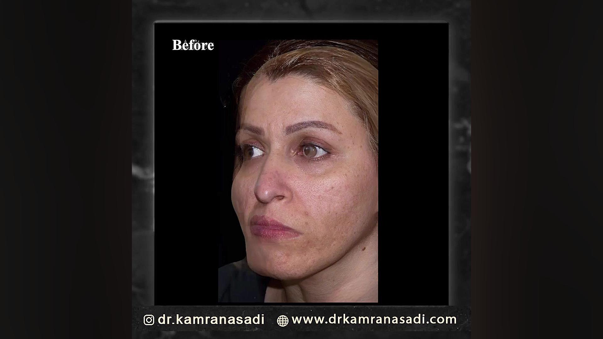 لیفت اندوسکوپیک پیشانی - صورت و جراحی زیبایی چانه پالپوتومی