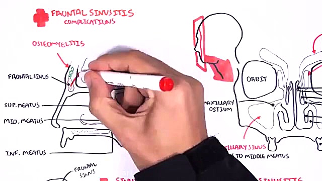 آناتومی بالینی حفره بینی پالپوتومی