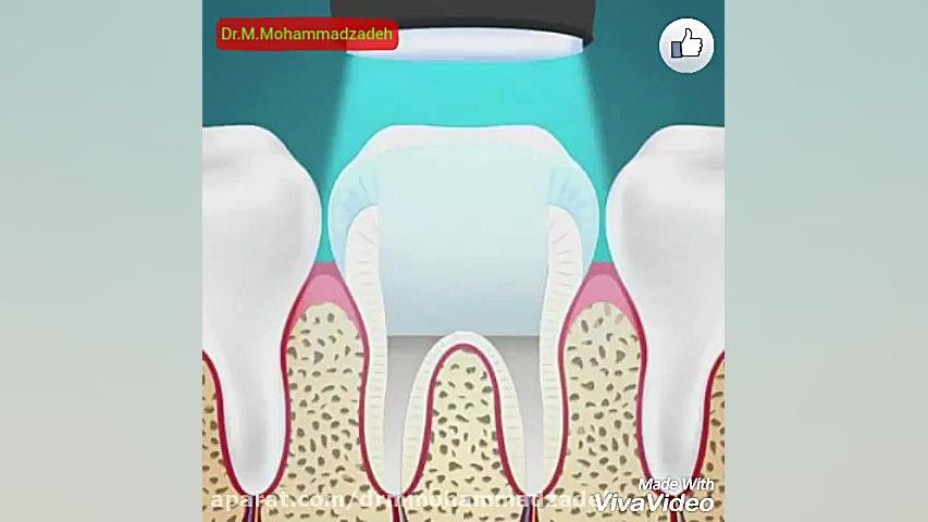 مراحل عصب کشی دندان چگونه است ؟ محمد محمدزاده دکتر محمد محمدزاده دندانپزشک