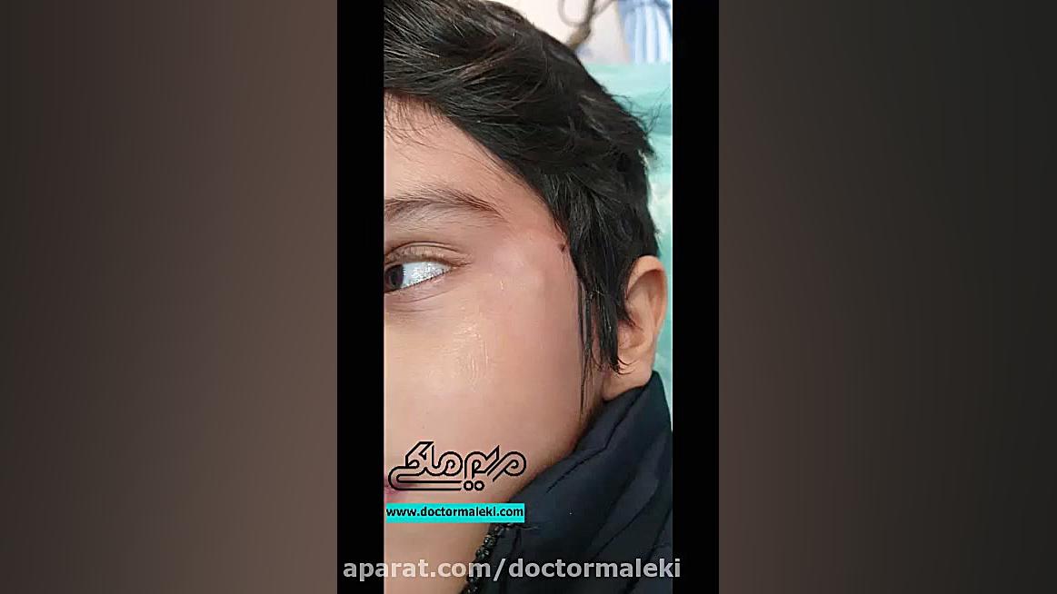 جراحی کیست اپیدرمال دکتر مریم ملکی - کلینیک پوست و مو و زیبایی هور