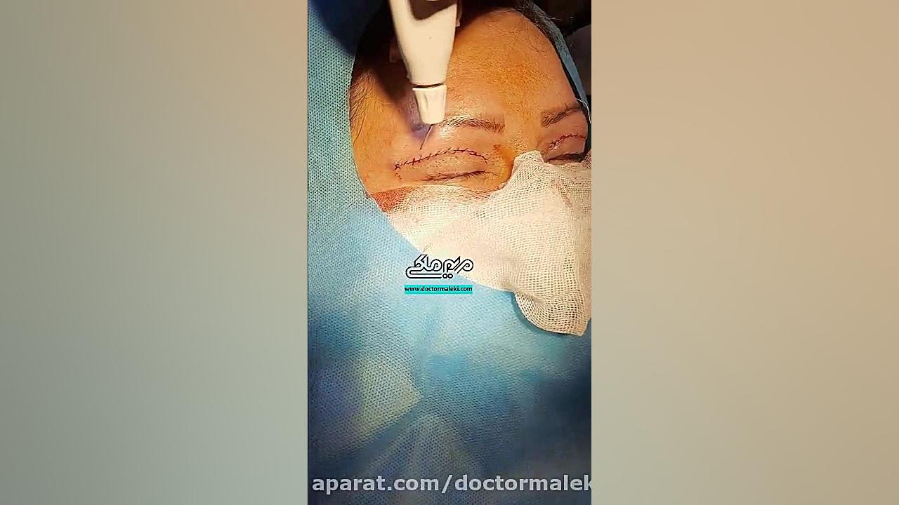 جراحی پلک دکتر مریم ملکی - کلینیک پوست و مو و زیبایی هور