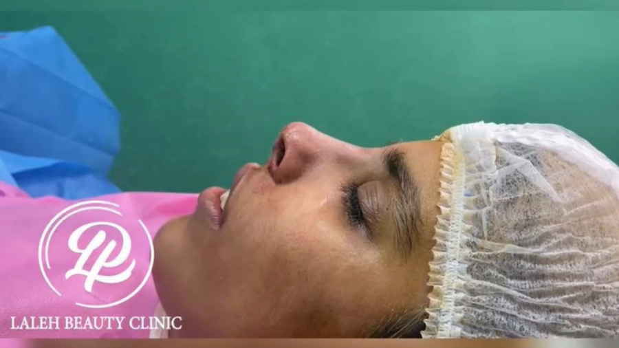 تیپ پلاستی - عمل بینی بدون بیهوشی - با بی حسی موضعی کلینیک دندانپزشکی