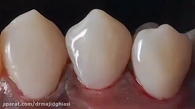 ترمیم پوسیدگی دندان دندان شیری