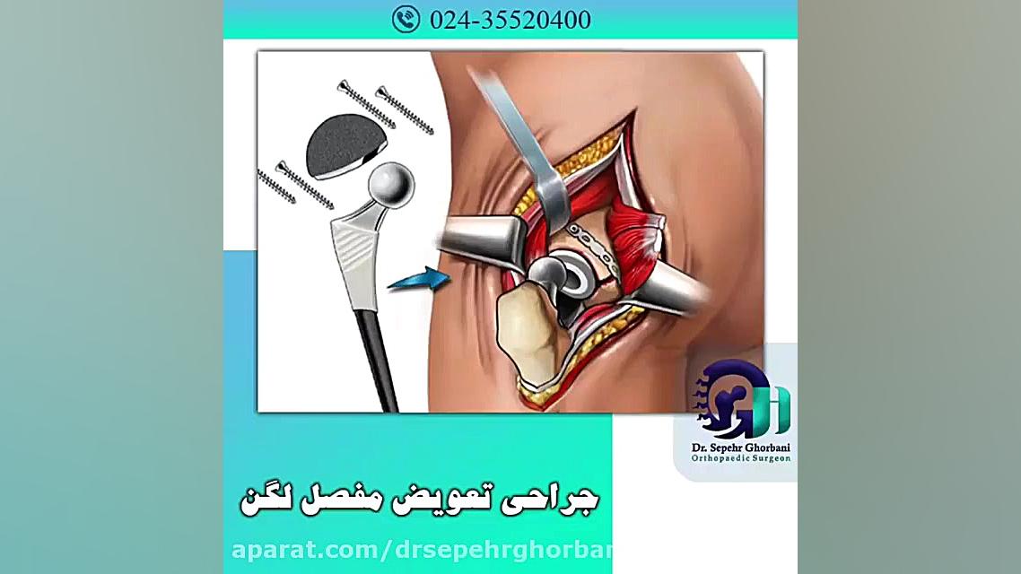 درمان شکستگی گردن فمور تحت جراحی تعویض مفصل لگن (همی ارتروپلاستی) پرویز پرستویی