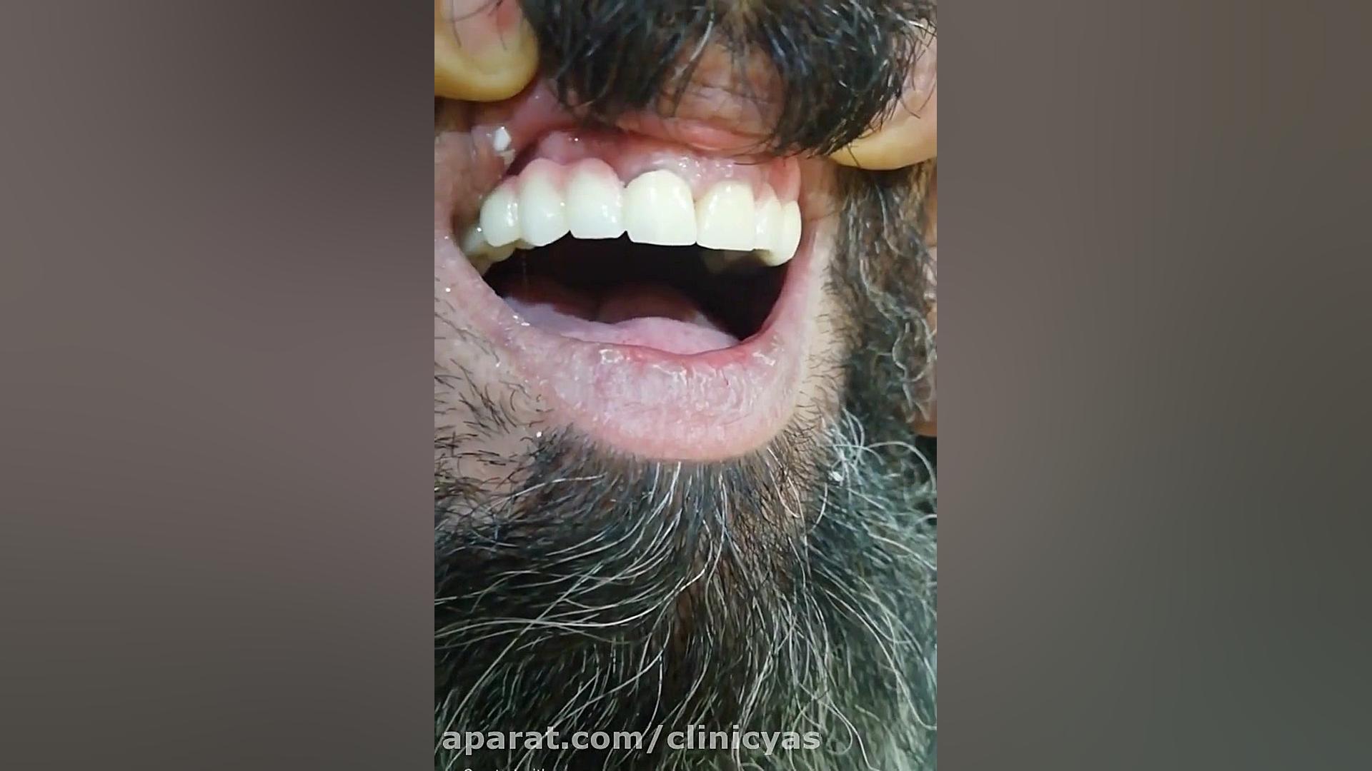 اصلاح طرح لبخند با روکش دندان ویروس‌شناسی انسانی