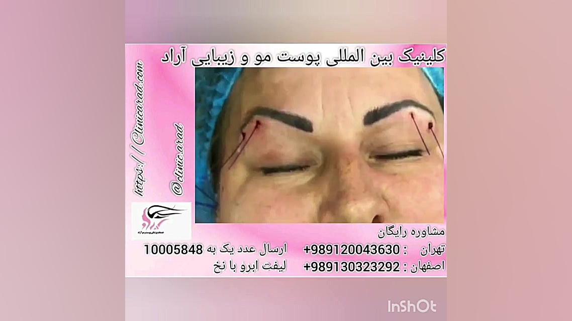 لیفت ابرو با نخ اکتروپیون