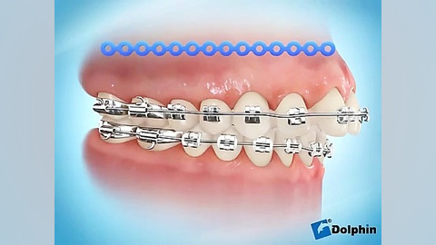 بستن فضای بین دندانی دکتر سهیل سالاری