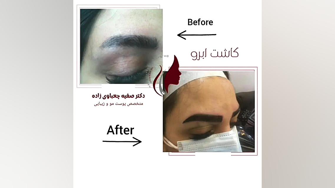 فیلم واقعی کاشت ابروی طبیعی دکتر صفیه چعباوی زاده