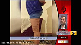 معلم قزوینی دانش آموزش را کبود کرد لیفت گردنایمپلنت دندان