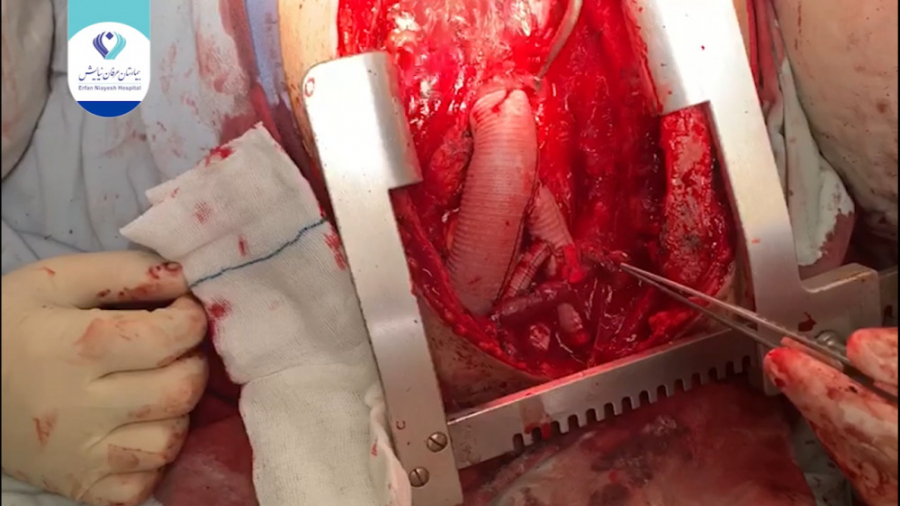 عمل Redo Aortic Arch Replacement and debranching کلیپ