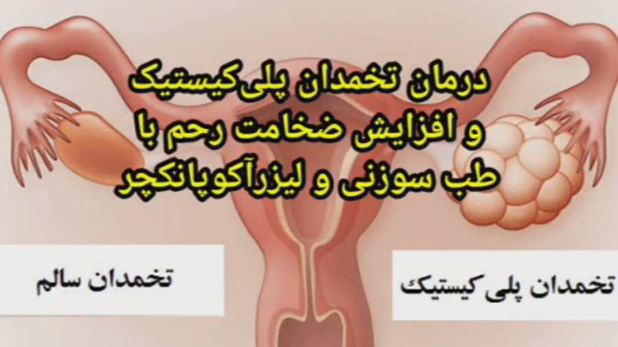 درمان تخمدان پلی کیستیک و افزایش ضخامت رحم دندان مصنوعی