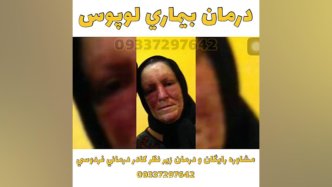 بيماري سخت و عجيب لوپوس درمان شد کامپوزیت ونیر