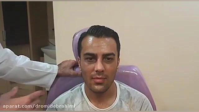 جراحی بینی طبیعی مردانه توسط دکتر امید ابراهیمی، بهترین جراح بینی طبیعی کار دکتر امید ابراهیمی