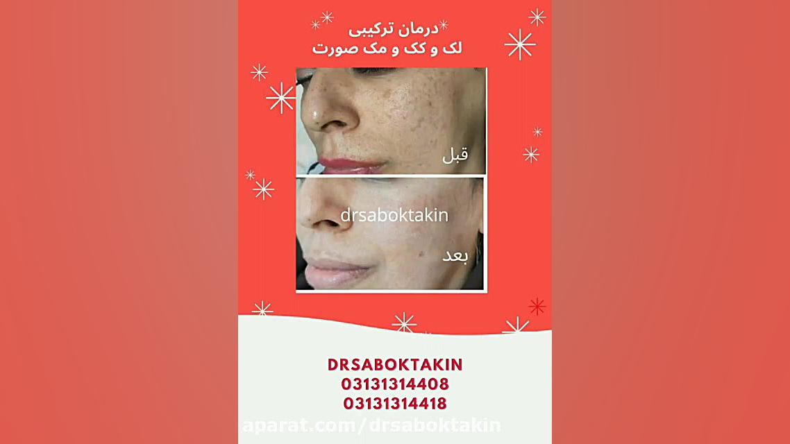 درمان ترکیبی اسکار آکنه در مطب دکتر سبکتکین متخصص پوست اصفهان متخصص پوست اصفهان دکتر مهدی سبکتکین