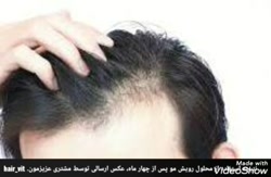 علت های ریزش مو
این عوامل شامل:

عوامل تغذیه ای
استرس های فیزیکی و روحی
بیماری د