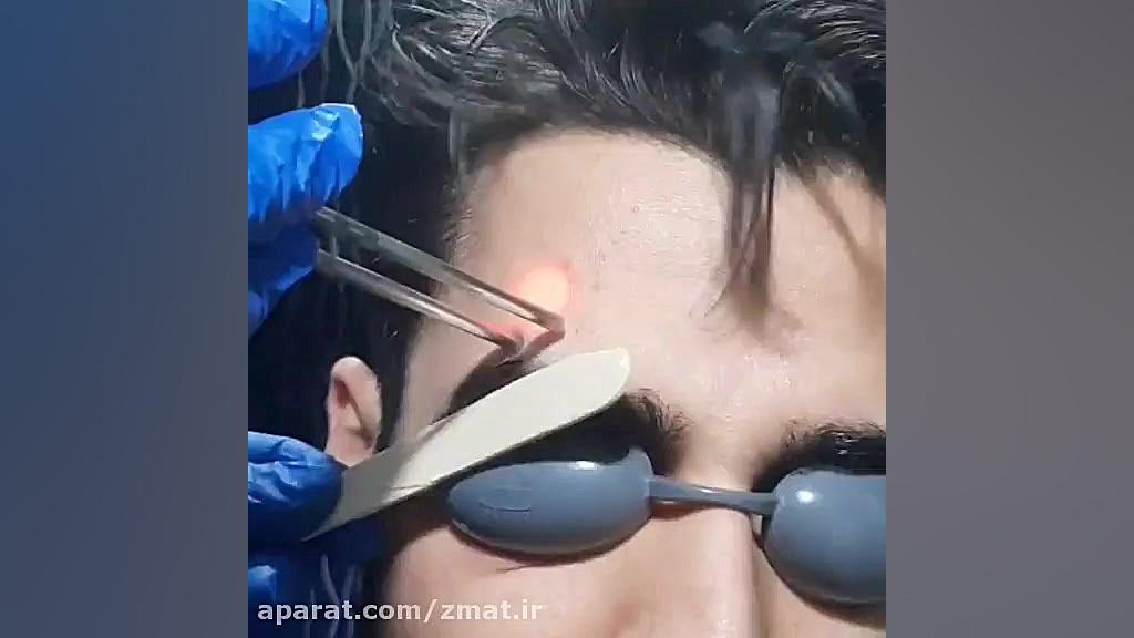 کلینیک تخصصی لیزر آریون رفع غبغب