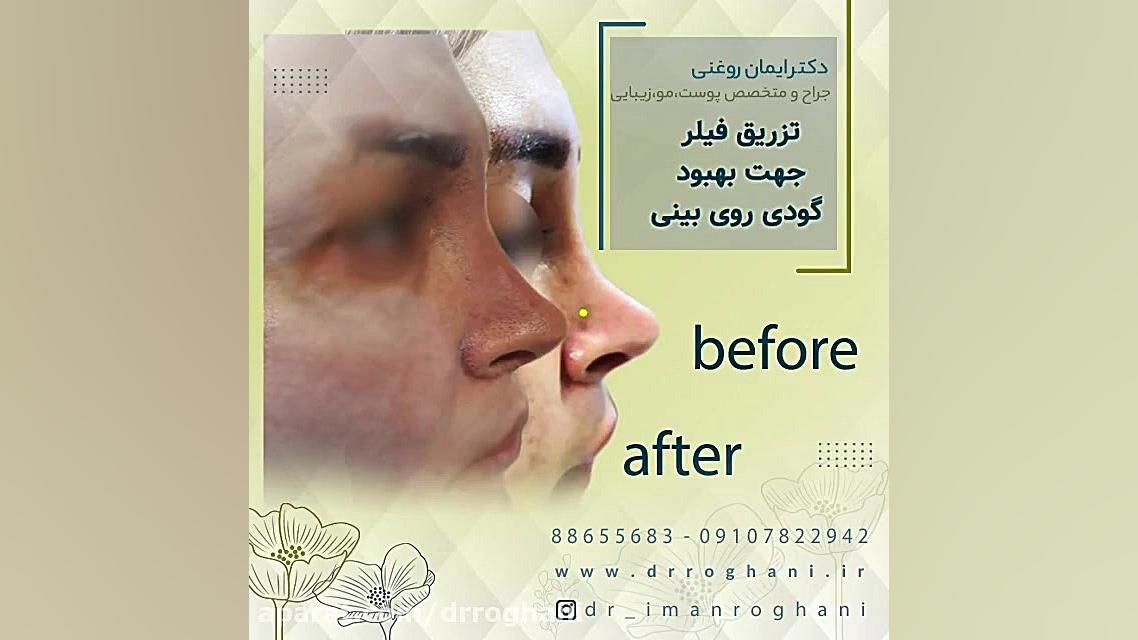 تزریق فیلر برای رفع گودی بیش از حد بینی دکتر ایمان روغنی جراح و متخصص پوست و مو