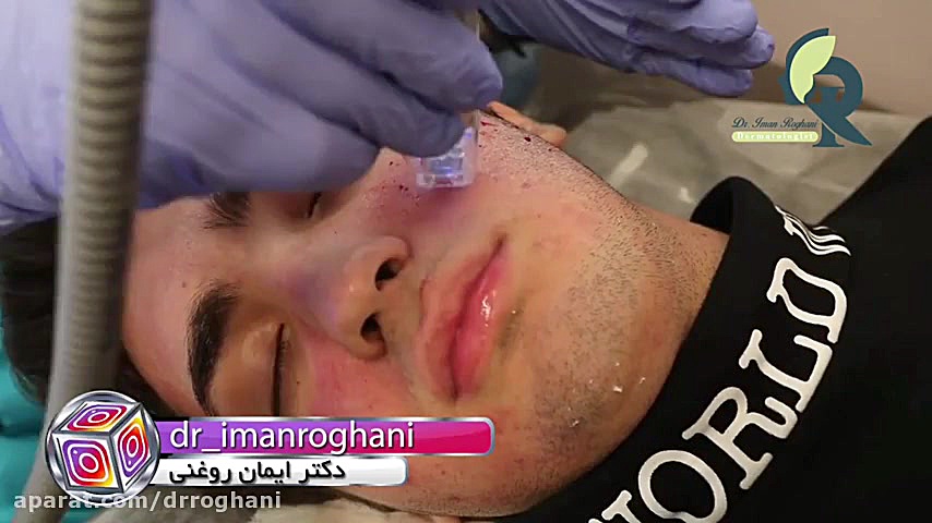 فیلم آر اف سوزنی برای از بین بردن جای جوش دکتر ایمان روغنی جراح و متخصص پوست و مو