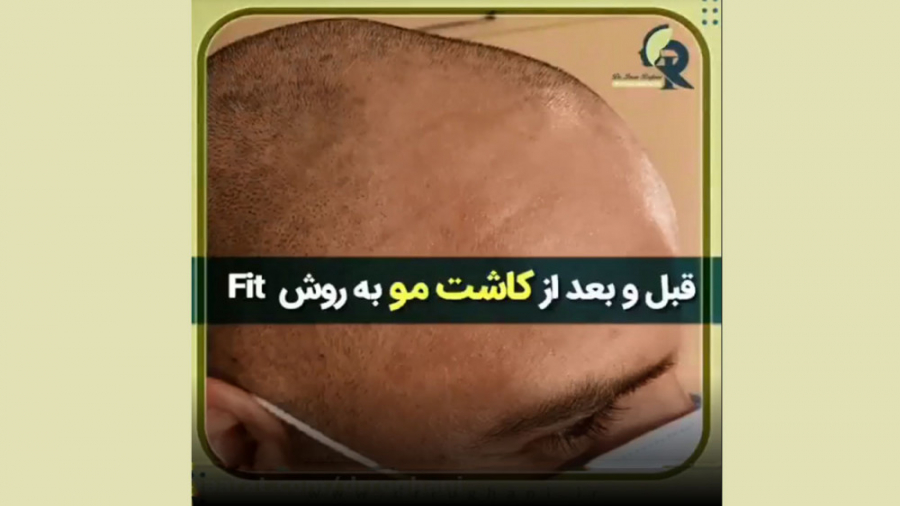 نتیجه کاشت مو به روش FIT دکتر ایمان روغنی جراح و متخصص پوست و مو