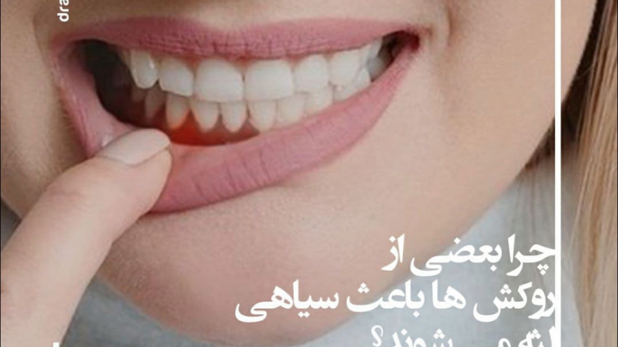 سیاه شدن لثه بعد از روکش دندان - دکتر غزال آرش راد متخصص ایمپلنت لیفت پیشانی