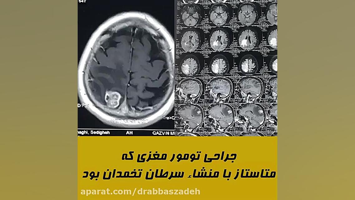 فیلم واقعی جراحی تومور مغزی - متاستاز با منشاء سرطان تخمدان تزریق چربی