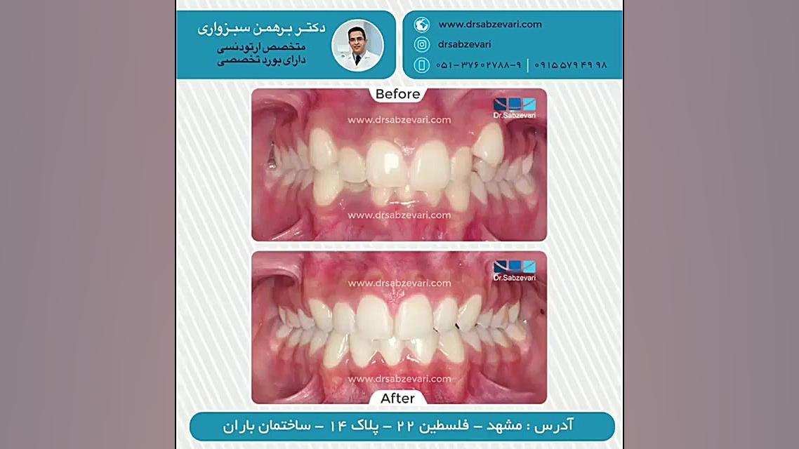 درمان ارتودنسی ثابت با کشیدن سه دندان دایمی دکتر برهمن سبزواری - متخصص ارتودنسی - مشهد