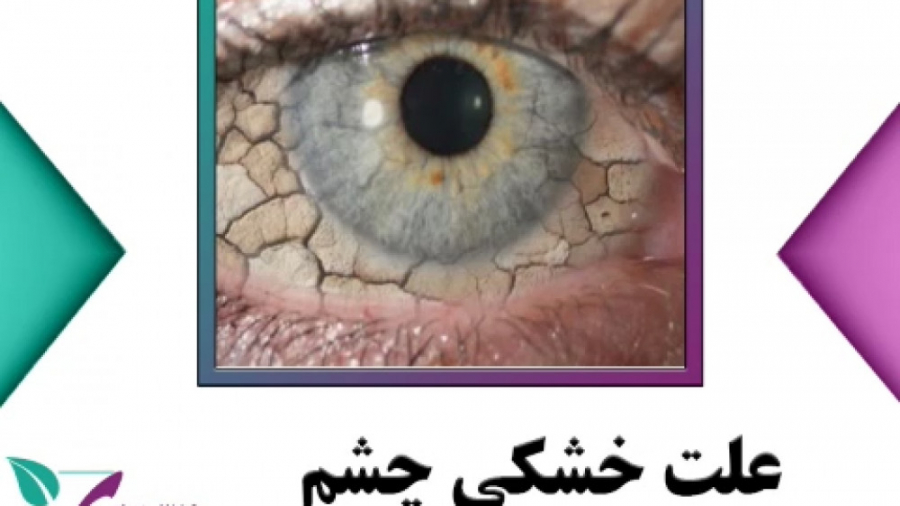 علل خشکی چشم و راه درمان آن دکتر فاطمه مرادی متخصص طب ایرانی