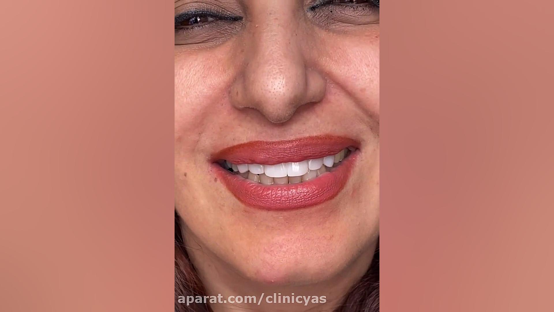 اصلاح طرح لبخند با کامپوزیت در دندانپزشکی یاس هایپرپاراتیروئیدیسم