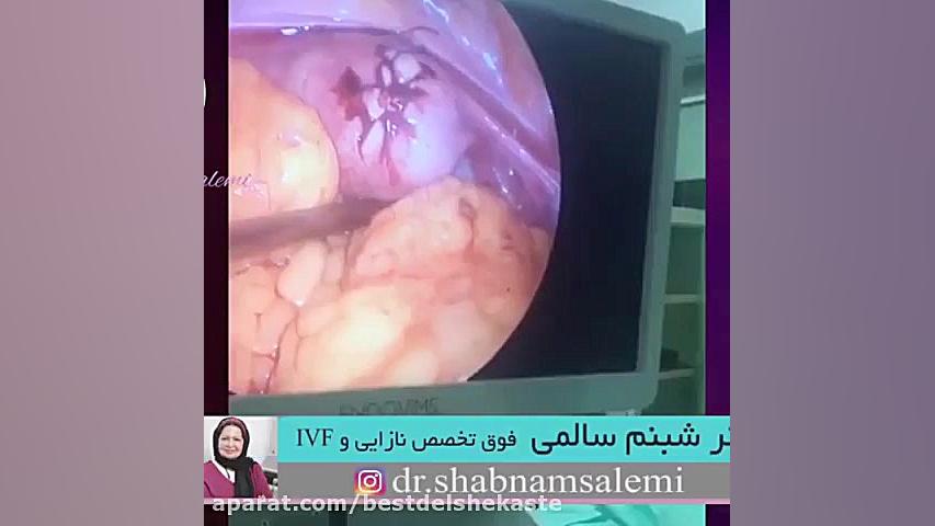 درمان فیبروم رحم با لاپاراسکوپی جوانسازی پوست
