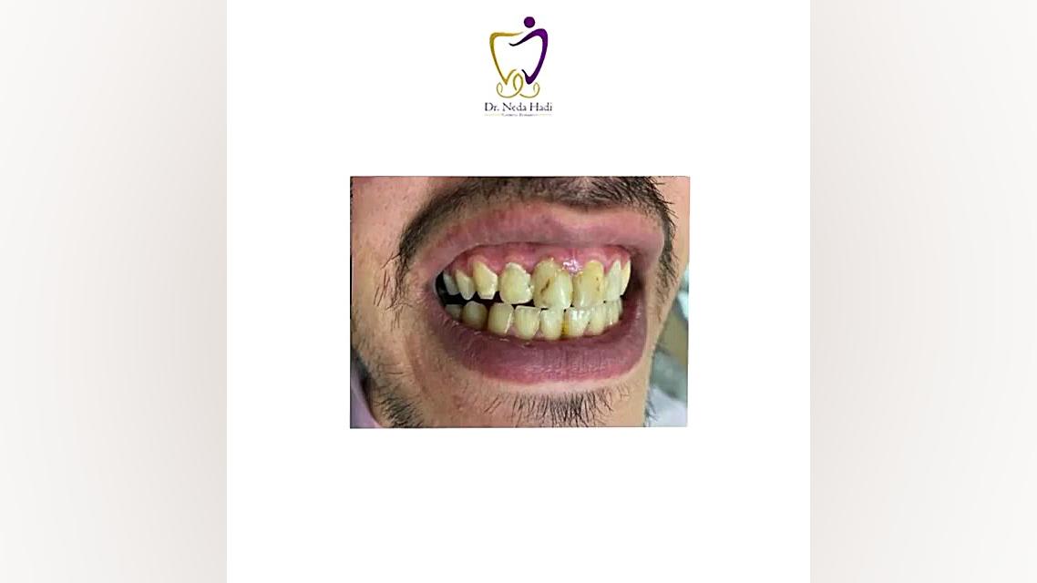 لبخند زیبای مراجعه کننده عزیزمون دکتر ندا هادی-دندانپزشک زیبایی