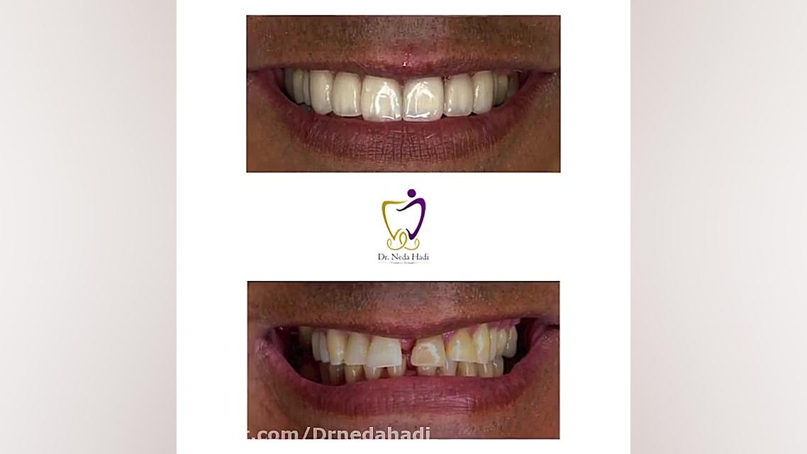 ‌انجام لمینیت سرامیکی برای مراجعه کننده عزیزمون دکتر ندا هادی-دندانپزشک زیبایی