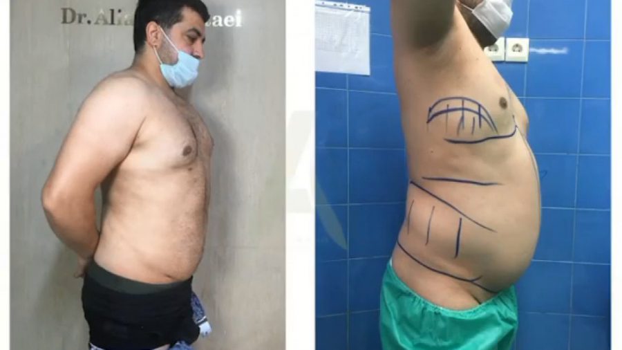 لیپوساکشن شکم پهلو - دکتر علی اکبر عطایی هایپرپاراتیروئیدیسم